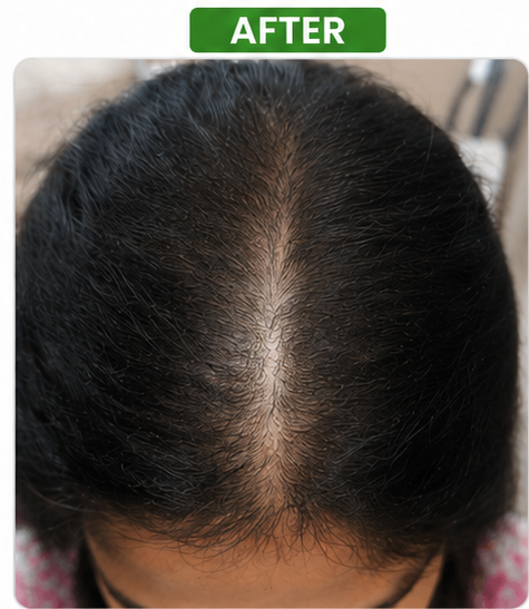 After Hair Density Treatment