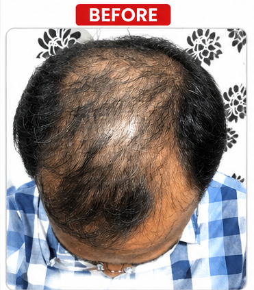 Before Hair Transplant